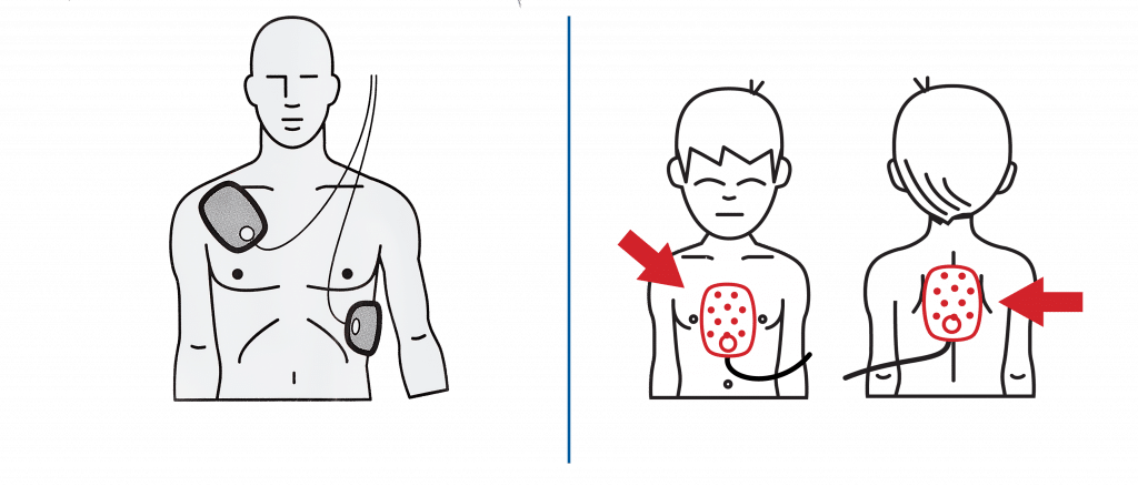 Positionnement des électrodes de défibrillation sur une victime adulte et sur une victime pédiatrique.
