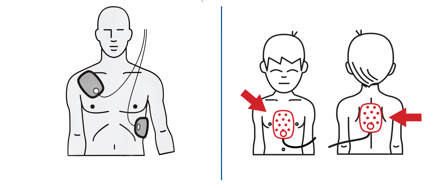 Guide Utilisation Défibrillateur (DAE) AVF Biomedical