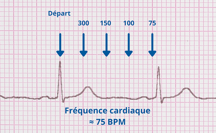 Exemple Méthode des 300 - ECG