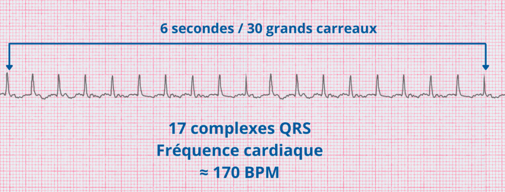 Exemple de la méthode des 6 secondes ECG