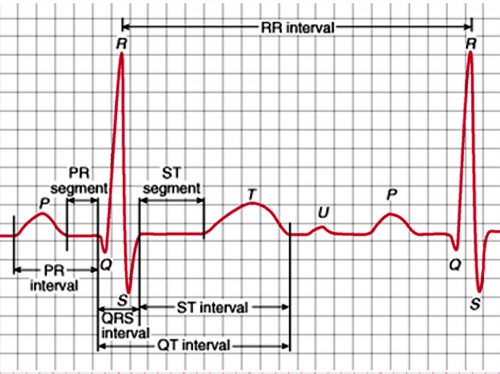 Définition d'un tracé ECg