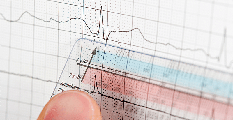 Utilisation de la règle pour ECG
