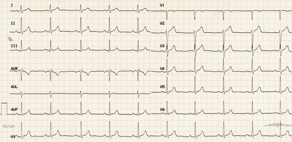 Tracé ECG normal