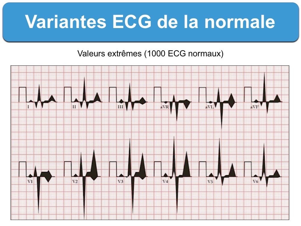 Tracé ECG: variantes de la normale