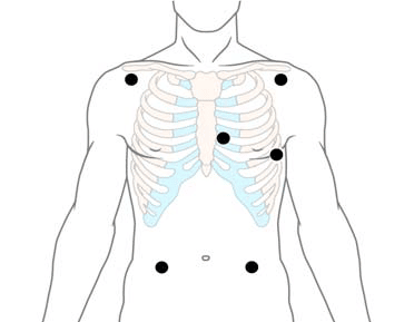 Position de Mason-Likar avec 6 électrodes