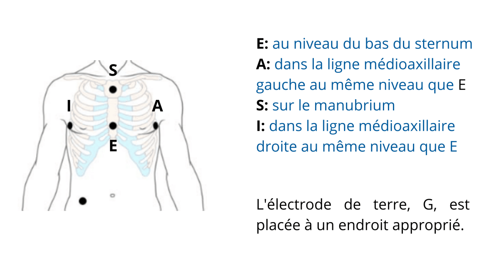 Quels sont les différents positionnements pour la surveillance ECG ? AVF Biomedical